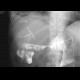 Biliary T-drain, drain into liver abscess, fistulography: RF - Fluoroscopy